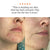 The Complete Acne System for Women