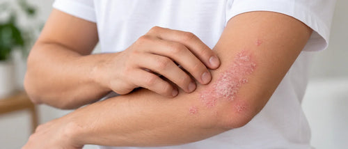 Natural Treatment for Psoriasis: A Topical Approach That Actually Helps