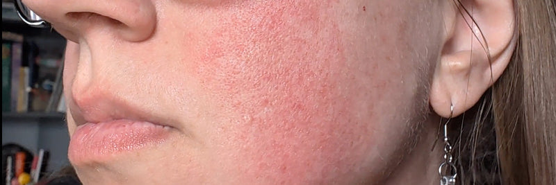 Best Rosacea Treatment for Women: How to Calm Redness and Flare-Ups Naturally