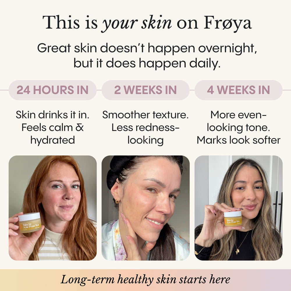 Balm for Acne-Prone Skin