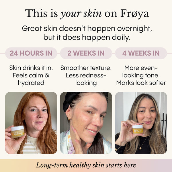 Balm for Acne-Prone Skin