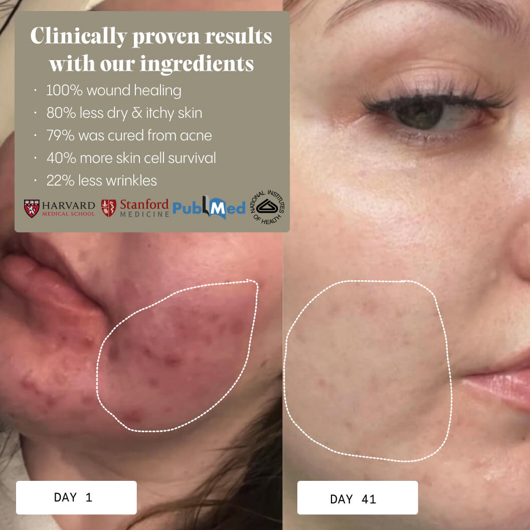 The Complete Acne System for Women