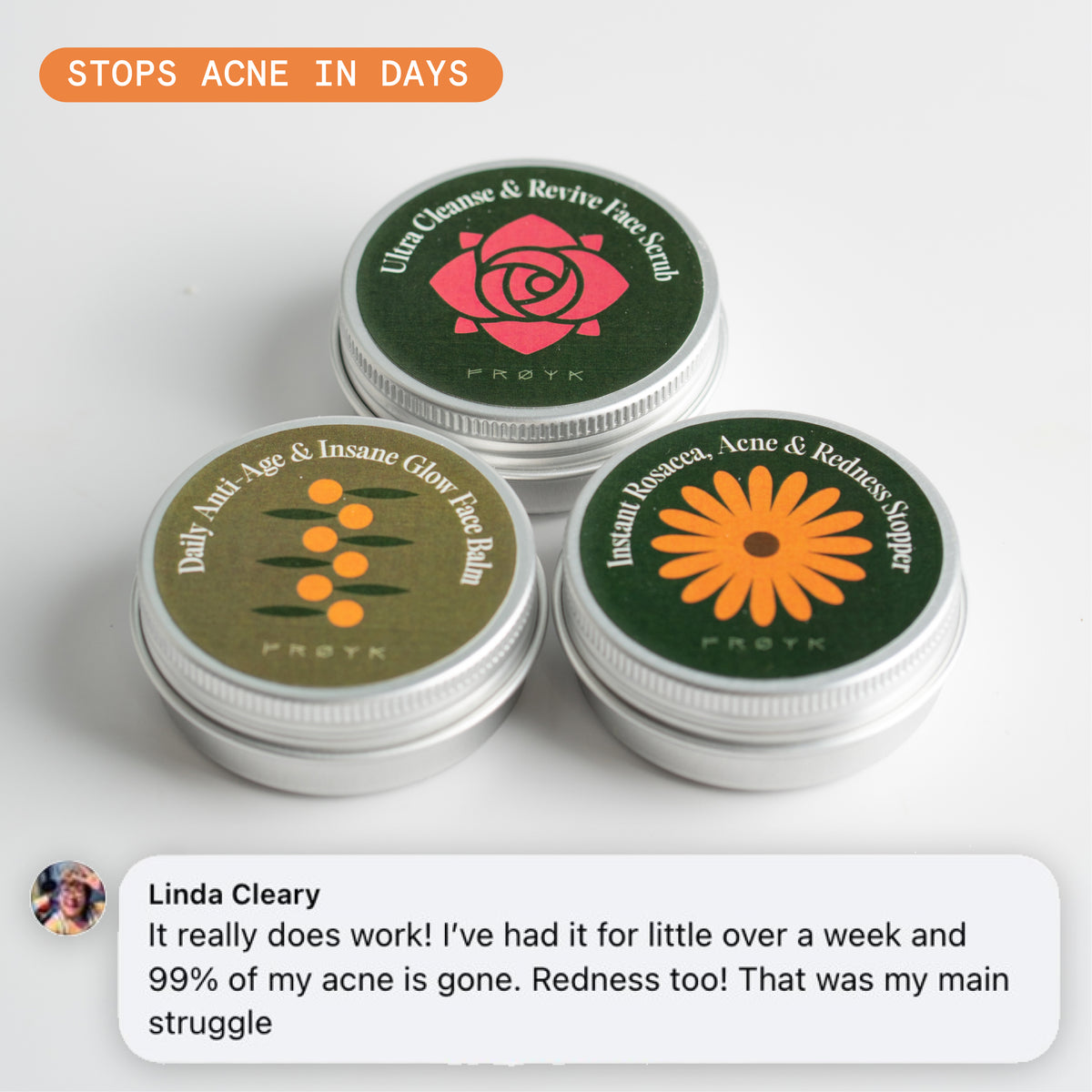 The Complete Acne System for Women