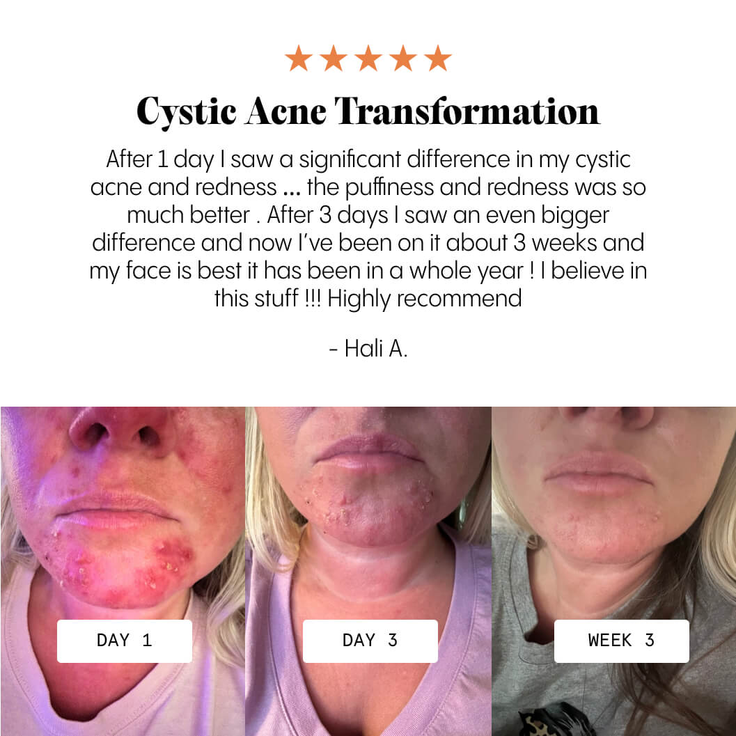 The Complete Acne System for Women