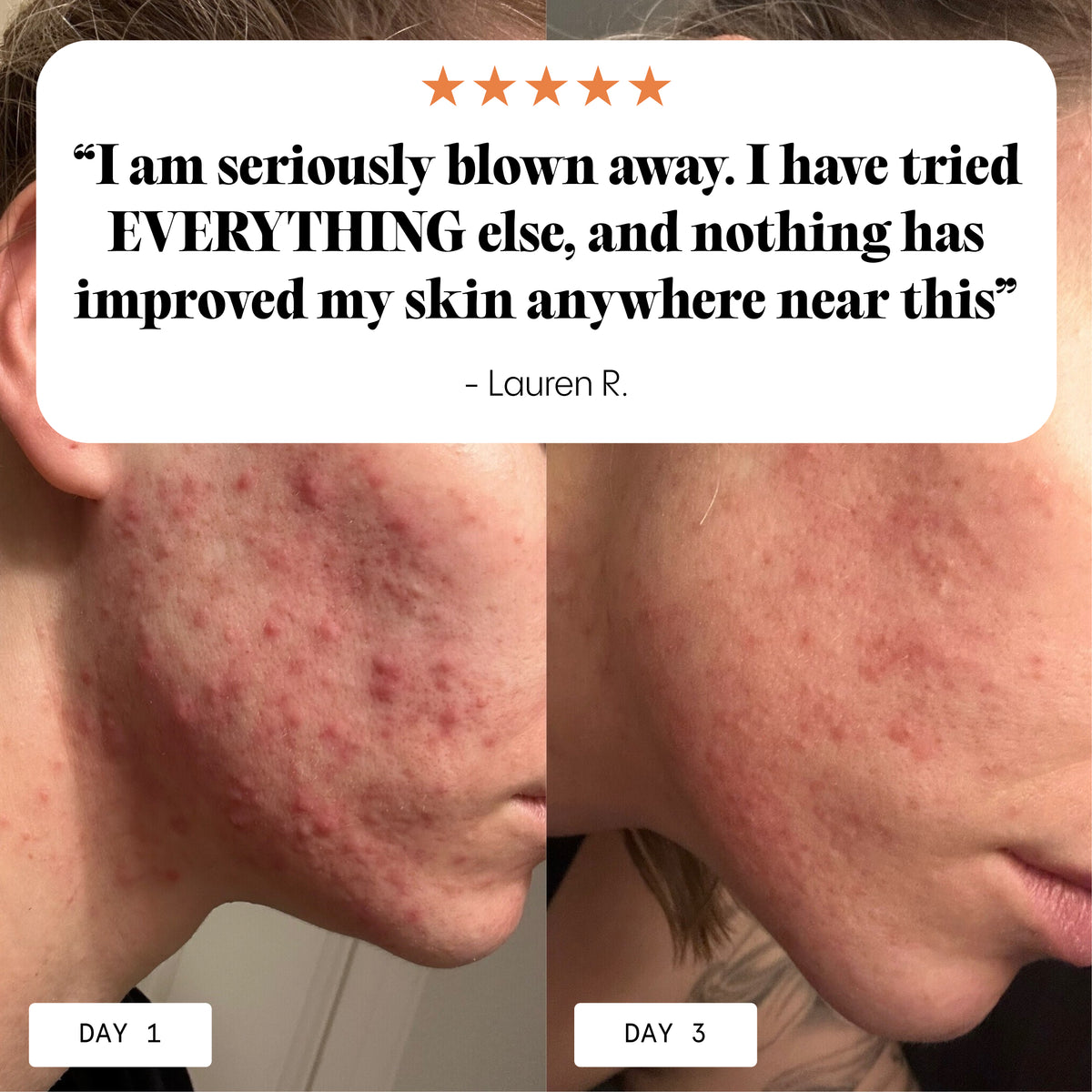 The Complete Acne System for Women