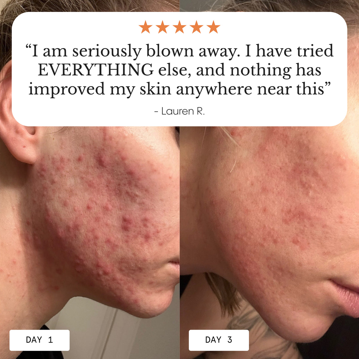 The Complete Acne System for Women