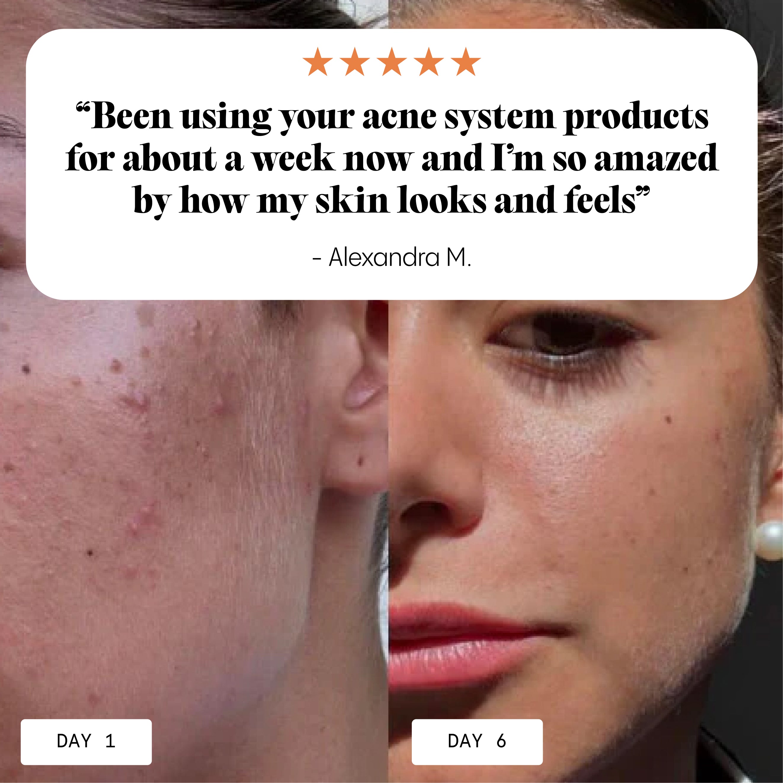 The Complete Acne System for Women