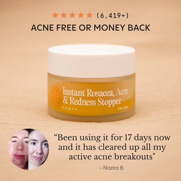 The Complete Acne System for Women