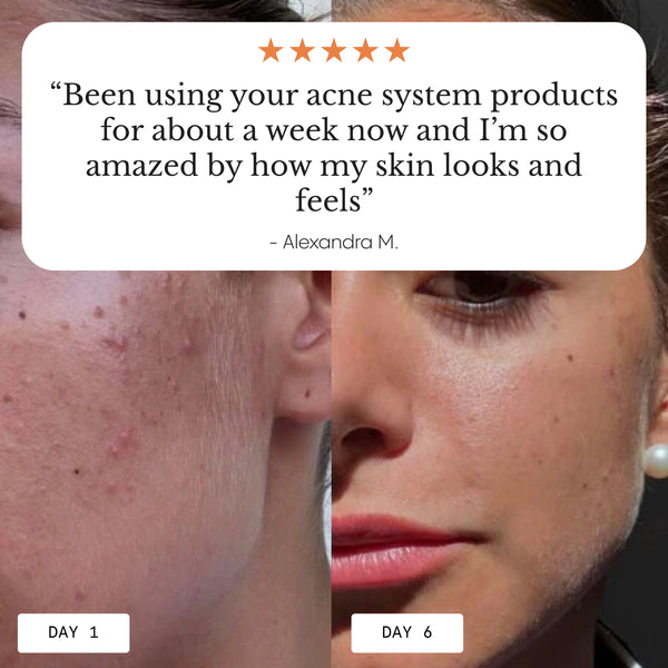 The Complete System for Acne-Prone Skin