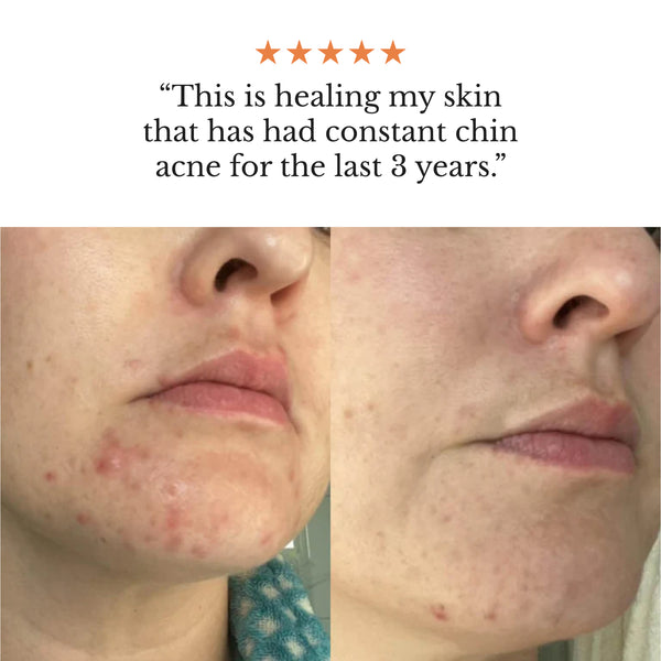 The Complete System for Acne-Prone Skin